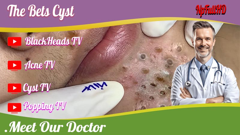 The Best Cyst